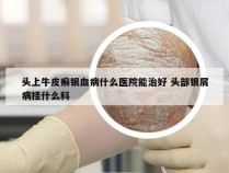 头上牛皮癣银血病什么医院能治好 头部银屑病挂什么科