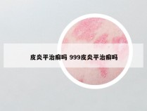 皮炎平治癣吗 999皮炎平治癣吗