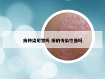 癣传染厉害吗 癣的传染性强吗