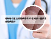 福州哪个医院银屑病看得好 福州哪个医院看银屑病最好