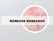 银屑病能吃带鱼 银屑病能吃带鱼吗