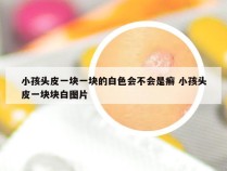 小孩头皮一块一块的白色会不会是癣 小孩头皮一块块白图片