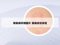 银癣病早期图片 银癣症状表现