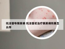 托法替布银屑病 托法替尼治疗银屑病效果怎么样