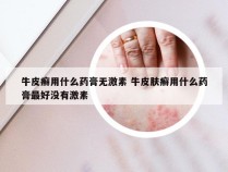 牛皮癣用什么药膏无激素 牛皮肤癣用什么药膏最好没有激素