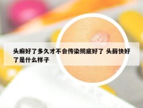 头癣好了多久才不会传染彻底好了 头藓快好了是什么样子