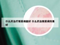 什么药治疗银屑病最好 什么药治银屑病效果好