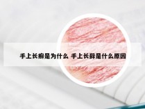 手上长癣是为什么 手上长藓是什么原因