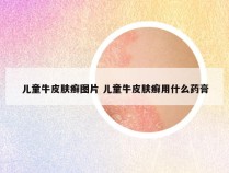 儿童牛皮肤癣图片 儿童牛皮肤癣用什么药膏