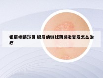 银屑病链球菌 银屑病链球菌感染复发怎么治疗