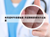 来月经时牛皮癣加重 月经期银屑病为什么加重