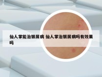 仙人掌能治银屑病 仙人掌治银屑病吗有效果吗