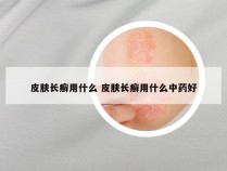 皮肤长癣用什么 皮肤长癣用什么中药好