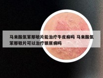 马来酸氯苯那敏片能治疗牛皮癣吗 马来酸氯苯那敏片可以治疗银屑病吗