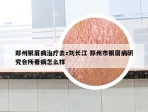 郑州银屑病治疗去z刘长江 郑州市银屑病研究会所看病怎么样