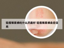 轻度银屑病吃什么药最好 轻度银屑病自愈征兆