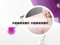 大腿癣症状图片 大腿癣症状图片