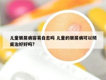 儿童银屑病容易自愈吗 儿童的银屑病可以彻底治好好吗?