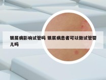 银屑病影响试管吗 银屑病患者可以做试管婴儿吗