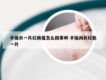 手指长一片红癣是怎么回事啊 手指间长红色一片