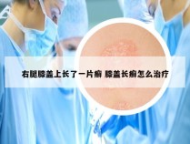 右腿膝盖上长了一片癣 膝盖长癣怎么治疗