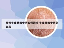 慢性牛皮肤癣中医如何治疗 牛皮肤癣中医怎么治