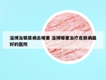 淄博治银屑病去哪里 淄博哪里治疗皮肤病最好的医院