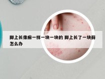 脚上长像癣一样一块一块的 脚上长了一块藓怎么办