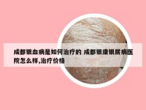 成都银血病是如何治疗的 成都银康银屑病医院怎么样,治疗价格