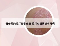 萧老师的拍打治牛皮癣 拍打对银屑病有用吗