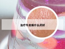 治疗牛皮癣什么药好