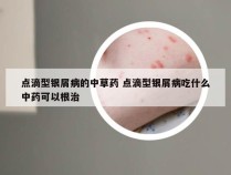 点滴型银屑病的中草药 点滴型银屑病吃什么中药可以根治