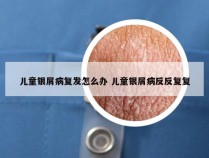 儿童银屑病复发怎么办 儿童银屑病反反复复