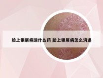 脸上银屑病涂什么药 脸上银屑病怎么消退