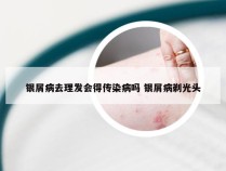 银屑病去理发会得传染病吗 银屑病剃光头