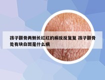 孩子颧骨两侧长红红的癣反反复复 孩子颧骨处有块白斑是什么病