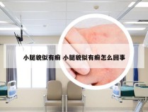 小腿貌似有癣 小腿貌似有癣怎么回事