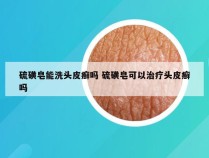 硫磺皂能洗头皮癣吗 硫磺皂可以治疗头皮癣吗