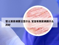 婴儿银屑病要注意什么 宝宝有银屑病摸什么药好