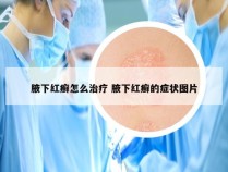 腋下红癣怎么治疗 腋下红癣的症状图片