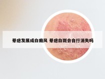 晕痣发展成白癜风 晕痣白斑会自行消失吗