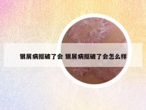 银屑病抠破了会 银屑病抠破了会怎么样