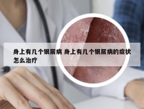 身上有几个银屑病 身上有几个银屑病的症状怎么治疗