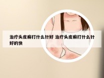 治疗头皮癣打什么针好 治疗头皮癣打什么针好的快