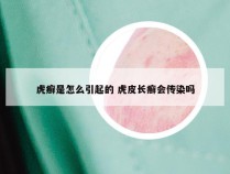 虎癣是怎么引起的 虎皮长癣会传染吗