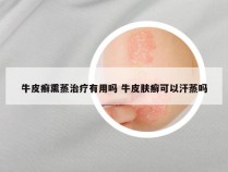 牛皮癣熏蒸治疗有用吗 牛皮肤癣可以汗蒸吗