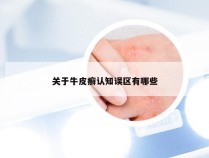 关于牛皮癣认知误区有哪些