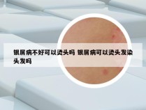 银屑病不好可以烫头吗 银屑病可以烫头发染头发吗