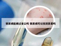 银屑病能瞒过老公吗 银屑病可以找到真爱吗