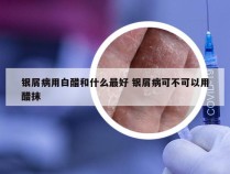 银屑病用白醋和什么最好 银屑病可不可以用醋抹